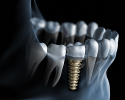 implant stomatologiczny