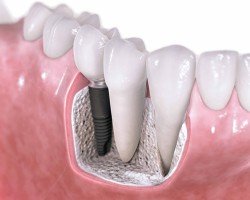 implant dentystyczny