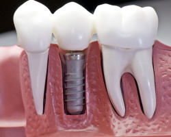 implant stomatologiczny